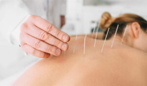 A hand places an acupuncture needle into the back of a resting woman