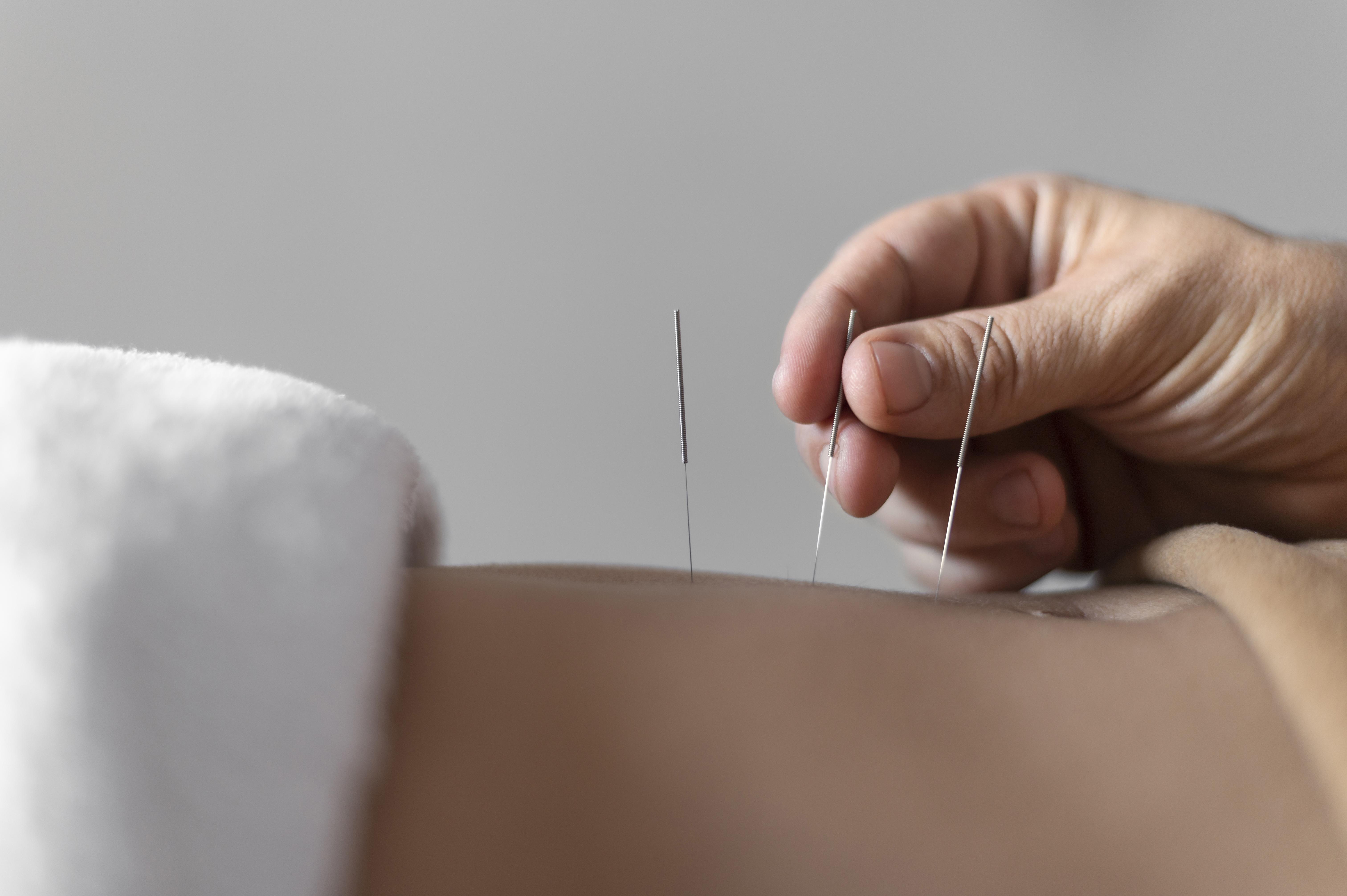 close up of hand holding acupuncture needles