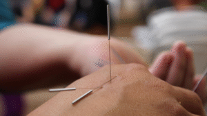 A close up image of a hand with multiple acupuncture needs embedded in it. A close up image of a hand with multiple acupuncture needs embedded in it.