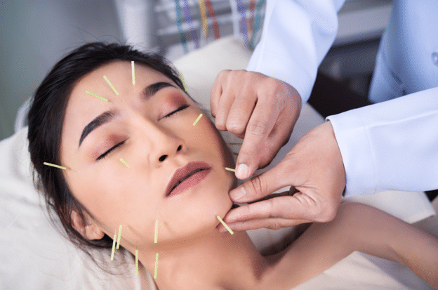 Close up of a woman receiving facial acupuncture treatment, with fine needles placed on her face while a practitioner adjusts them.